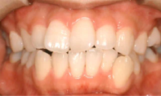 歯科矯正治療例01
