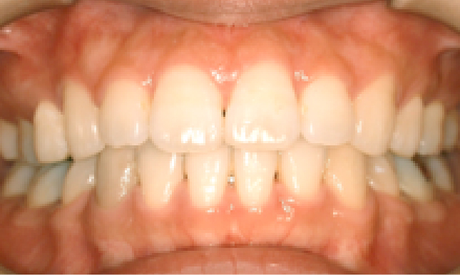 歯科矯正治療例02
