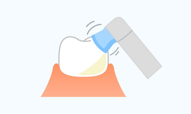 歯のクリーニング(PMTC)プロフェッショナル メカニカル トゥース クリーニング01